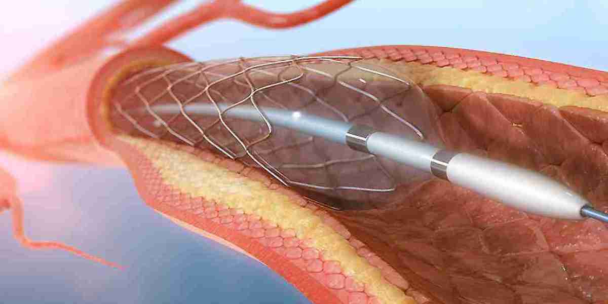 Angioplasty Balloons Market Innovations: Introduction of Bioabsorbable and Drug-Coated Balloons Revolutionizing Treatmen