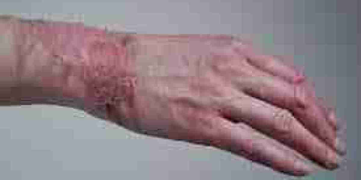 Skin replacement market opportunities: Uncovering unexplored segments and new markets for skin replacement products glob