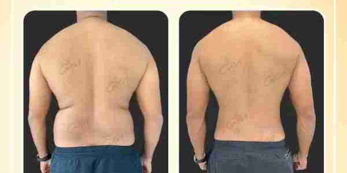 Achieve a Sculpted Look with Liposuction in Dubai by Dr. Hans