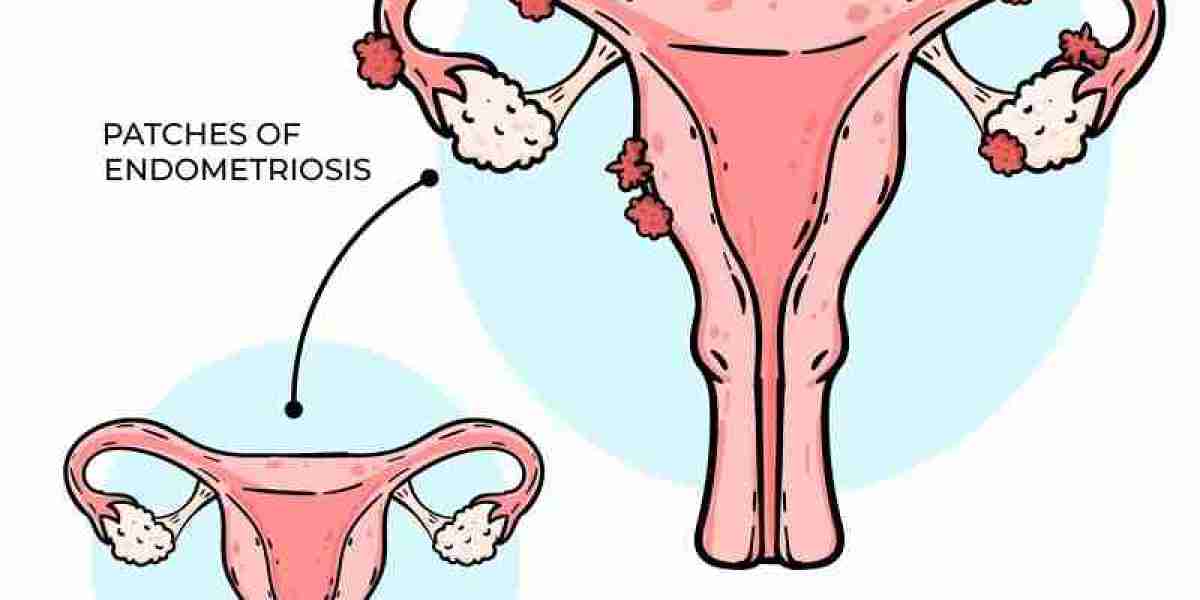 Early Signs of Endometriosis: Key Symptoms You Shouldn’t Ignore