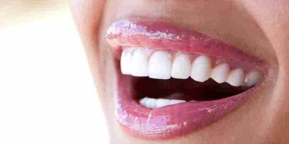 How Long Does a Nano Teeth Whitening Session Take?