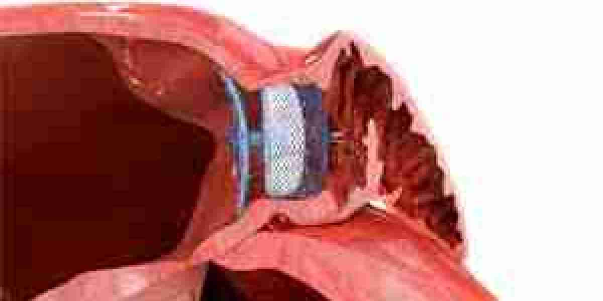 Atrial Fibrillation Device Market: Competitive Analysis of Key Players and Market Dynamics
