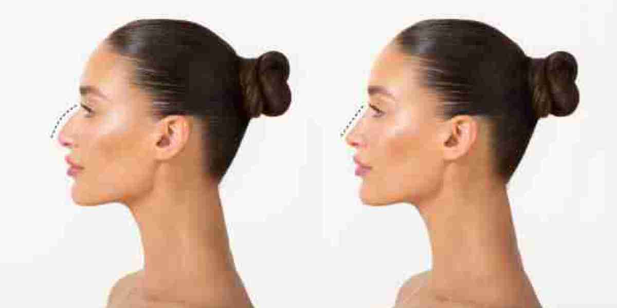 Is Rhinoplasty Surgery in Riyadh Right for You? Find Out