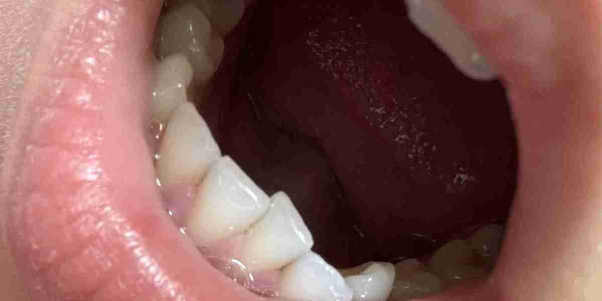 Can Overlapping Teeth Lead to Jaw Pain?