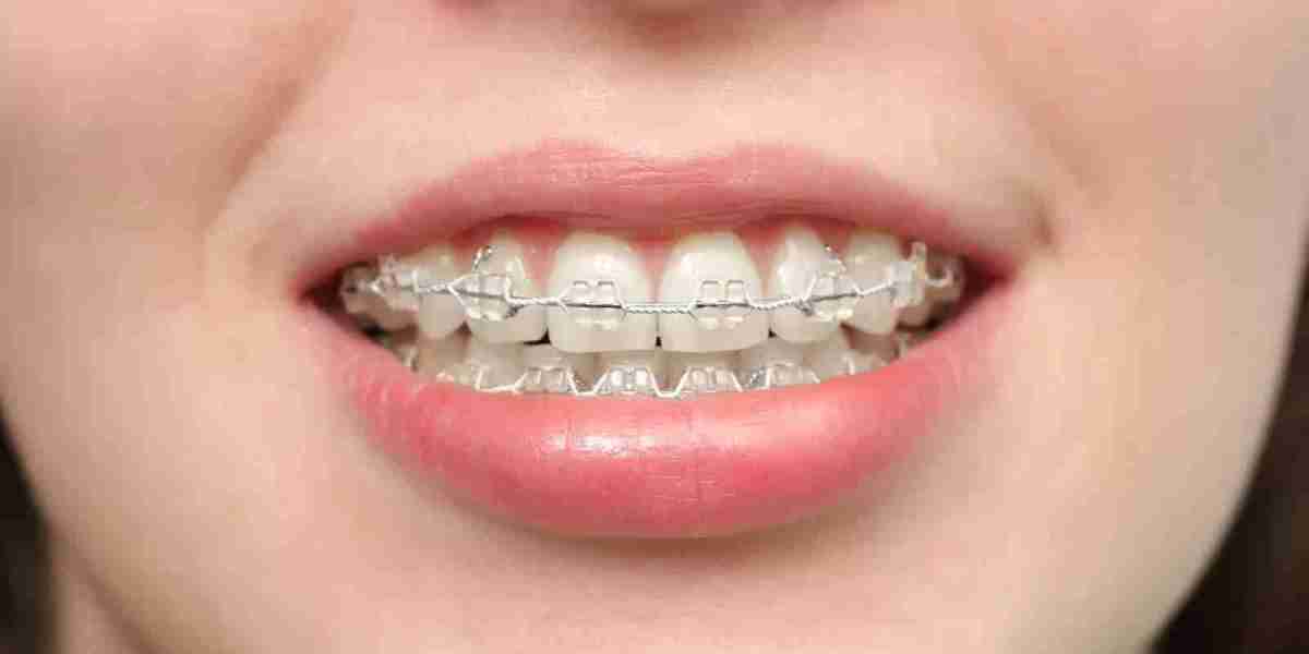 What Is the Recovery Time After Getting Metal Braces?