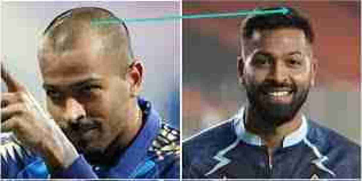 Transforming Hair, Restoring Confidence: Hair Transplant in Gurgaon & Noida by Dr. Amit Gupta at Divine Cosmetic Sur