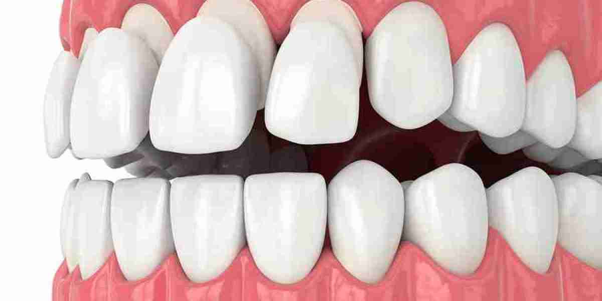How to Choose the Right Dentist for Composite Veneers?