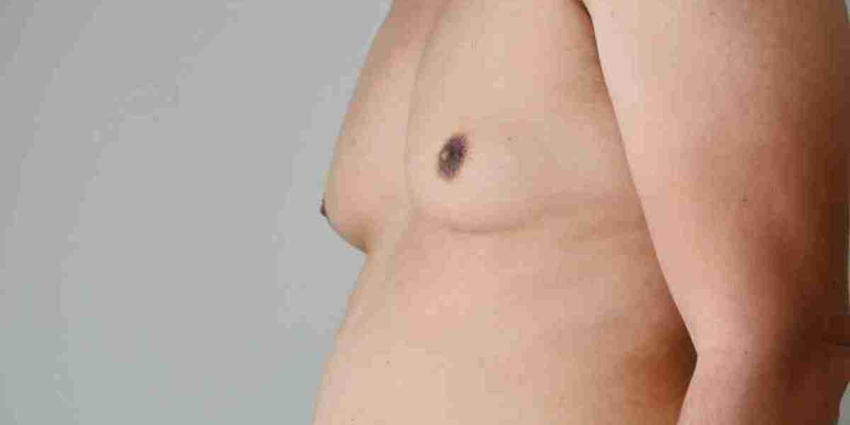 How Does Gynecomastia Surgery Impact Your Physical Health?
