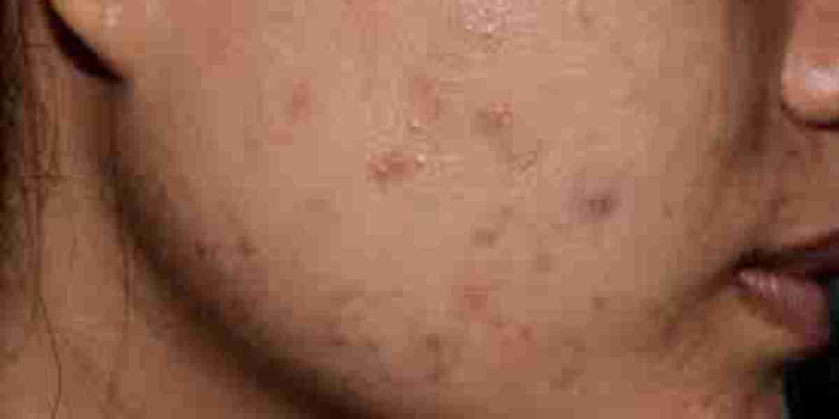 Acne Scar Treatment Mistakes to Avoid Right Now