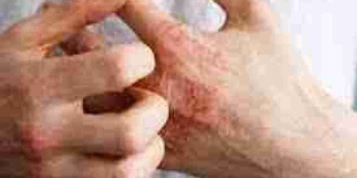 Atopic Dermatitis Market Threats: Impact of Generic Competition on Drug Pricing and Innovation