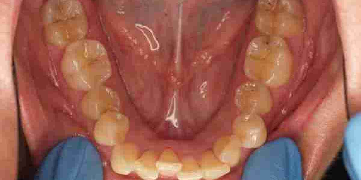 How Can Kids with Crowded Teeth Be Treated Early?