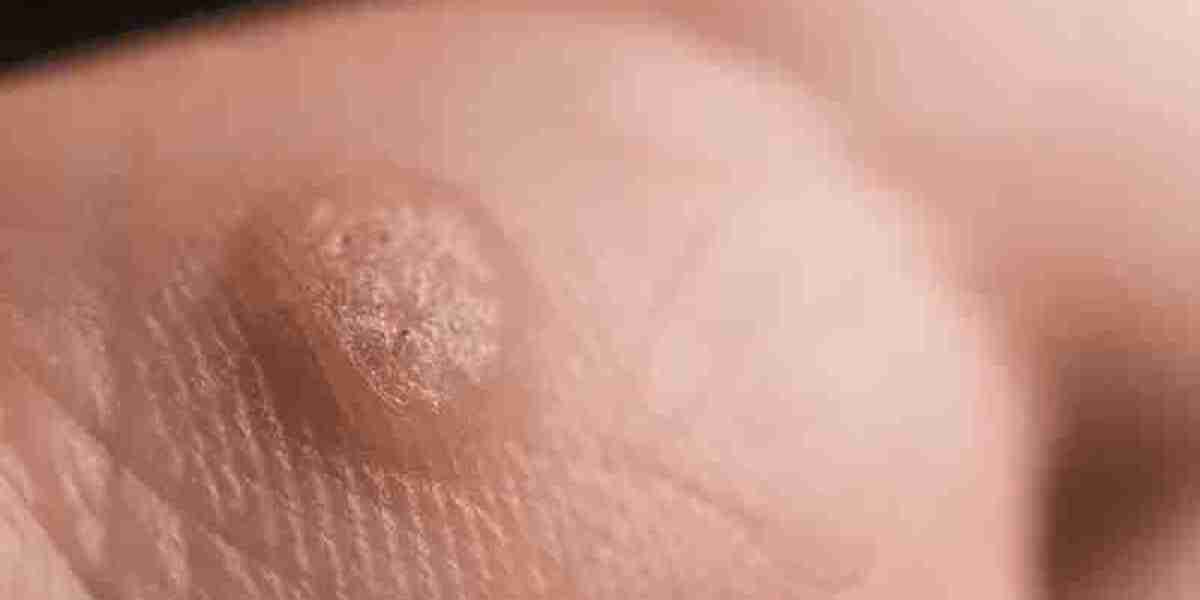 Using Salicylic Acid to Help Remove Warts Fast and Safely
