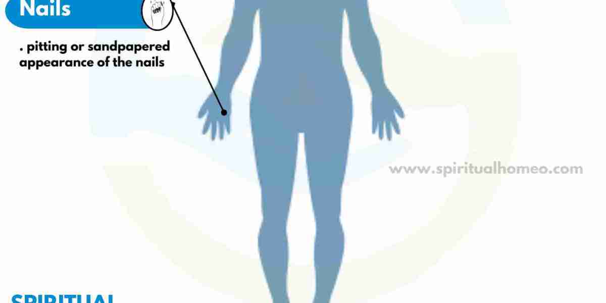 Homeopathy in Hyderabad for Alopecia: A Natural Approach to Hair Loss Recovery