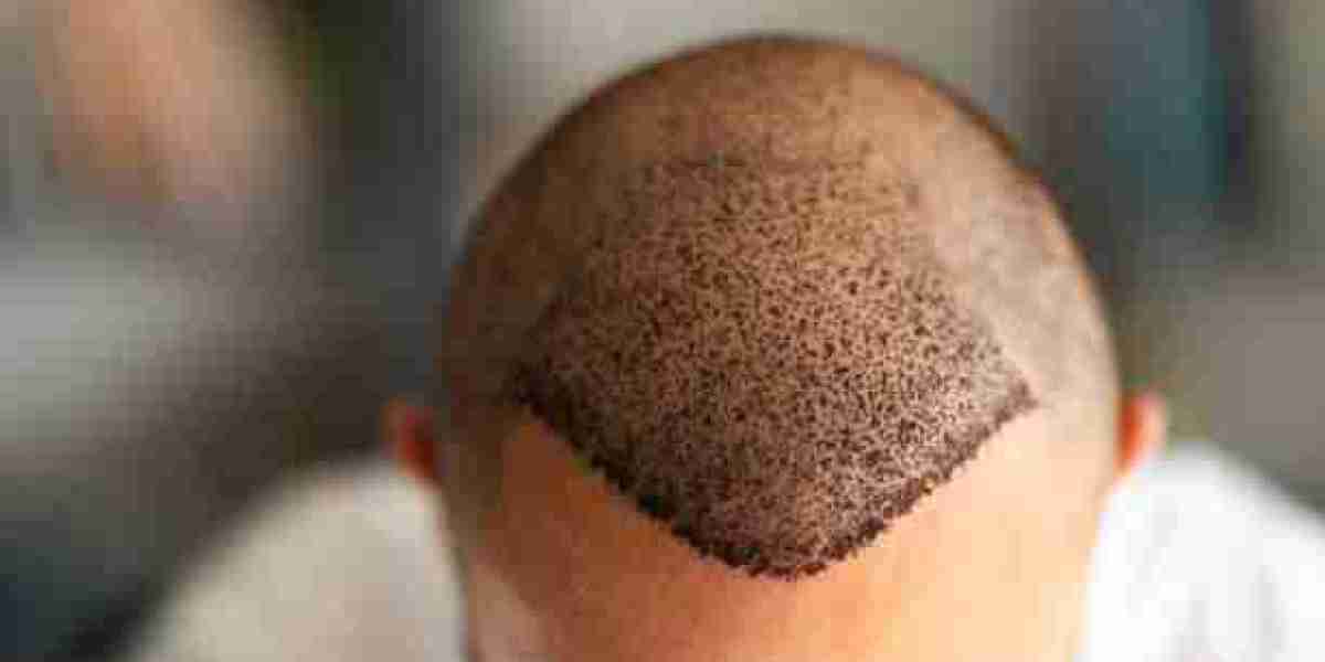 Hair Loss Treatment Products with Best Customer Reviews