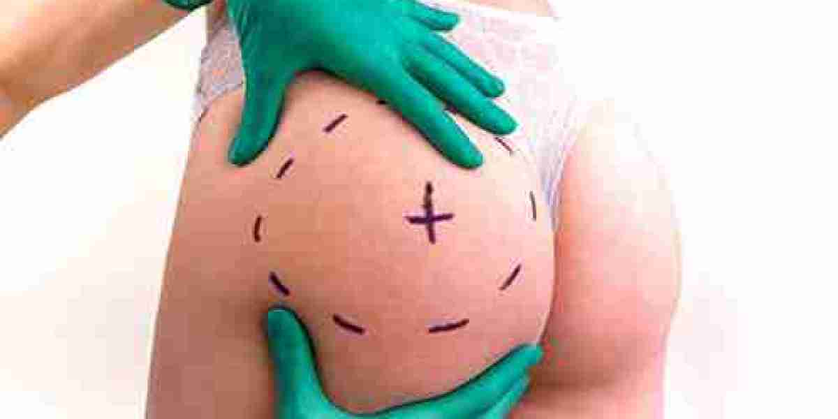 How Long Before You See Results from Buttock Augmentation?