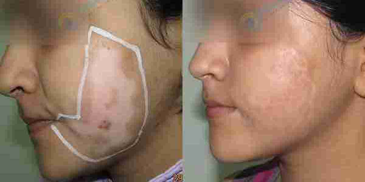 Understanding Vitiligo: Symptoms, Types & Treatment Options in Delhi