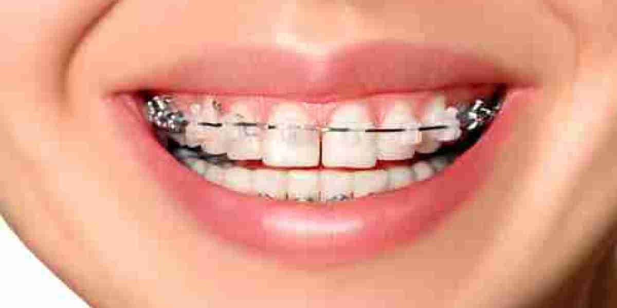 How to Handle Braces Discomfort at Home
