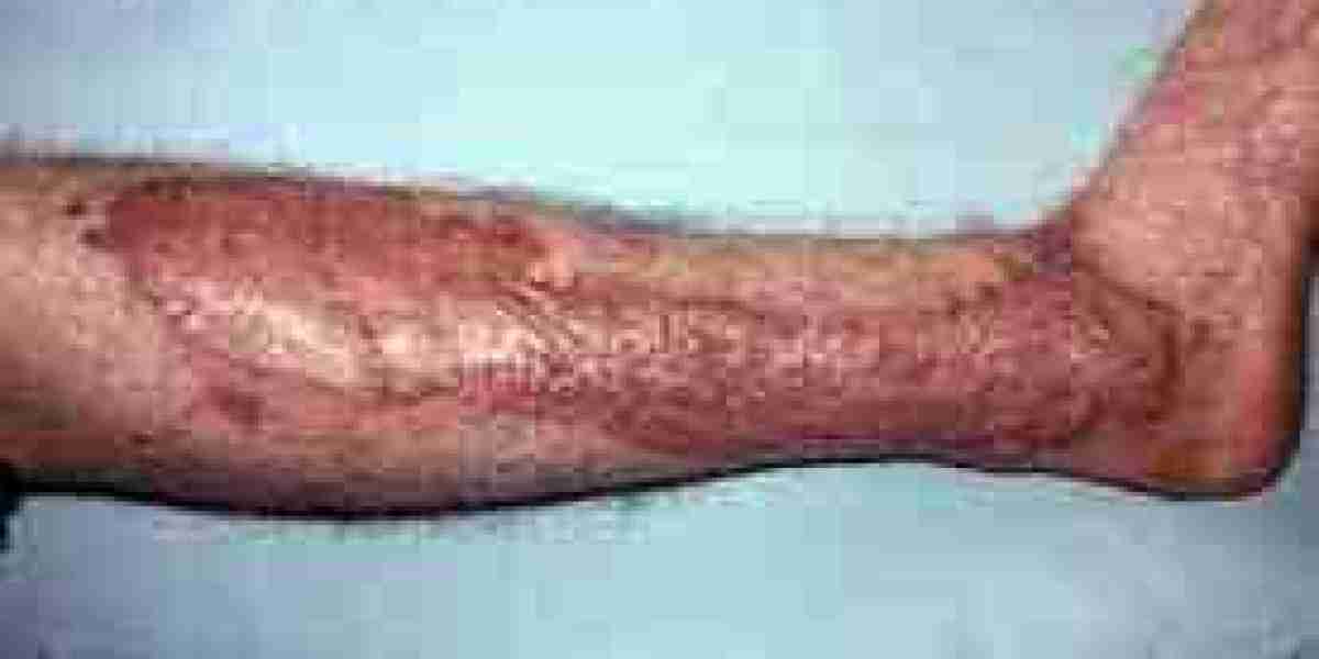 Skin Replacement Market Insights: Consumer Behavior Trends and Market Adoption Rates