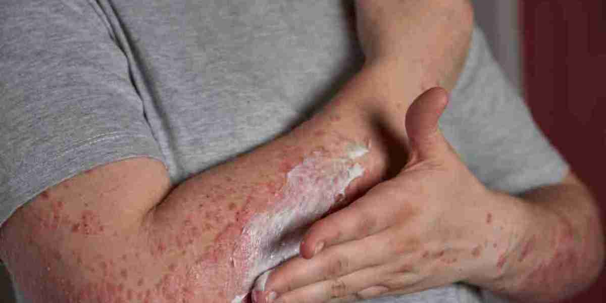 Risks of reconstructive burn surgery explained
