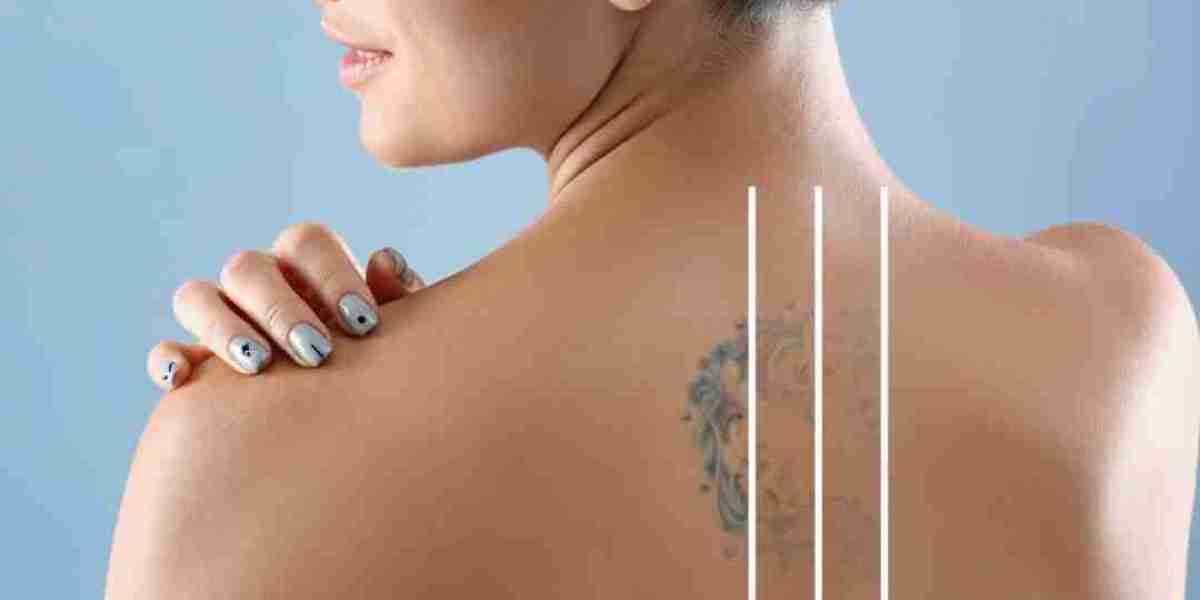 Can Cosmetic Tattoos Be Removed with Laser?