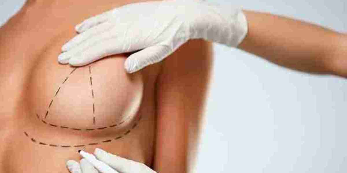 Male Breast Reduction in Riyadh: Reclaiming a Masculine Physique