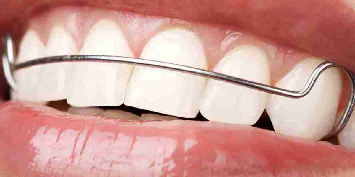 Will Insurance Cover Dental Retainers?