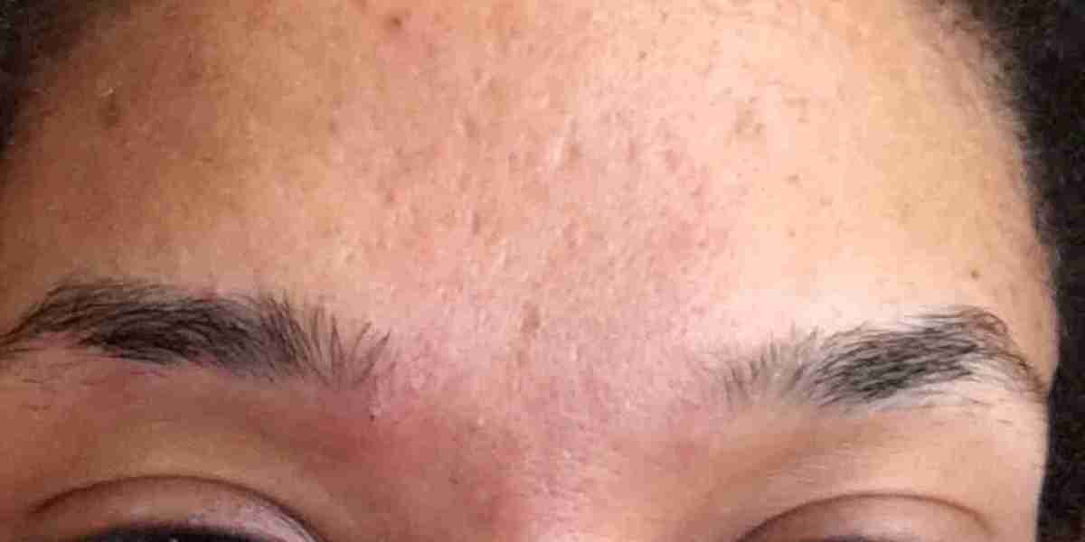 Anti-Acne Dermal Patch Market: Exploring Emerging Trends, Innovations, and Global Growth Opportunities