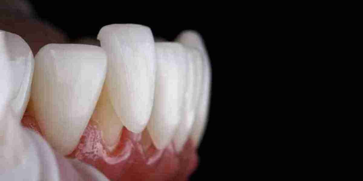 How Do Composite Veneers Improve My Smile?