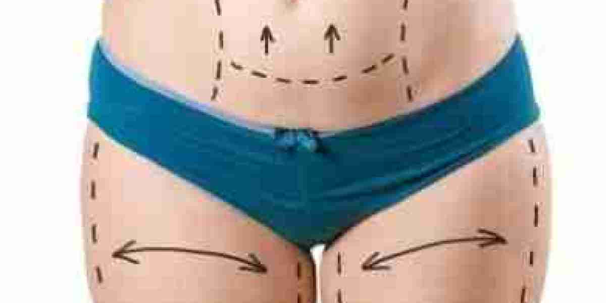 Precision Contouring: SmartLipo in Riyadh - What to Know