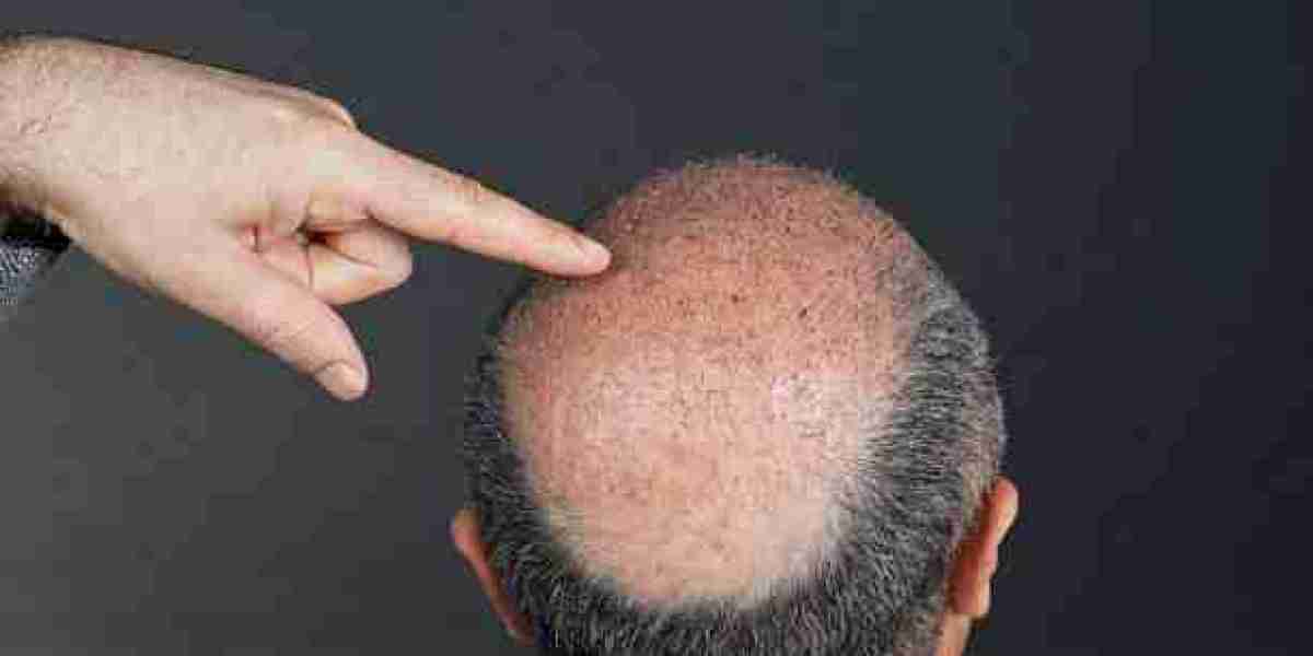 FUE Hair Transplant in Riyadh for Natural Hairlines