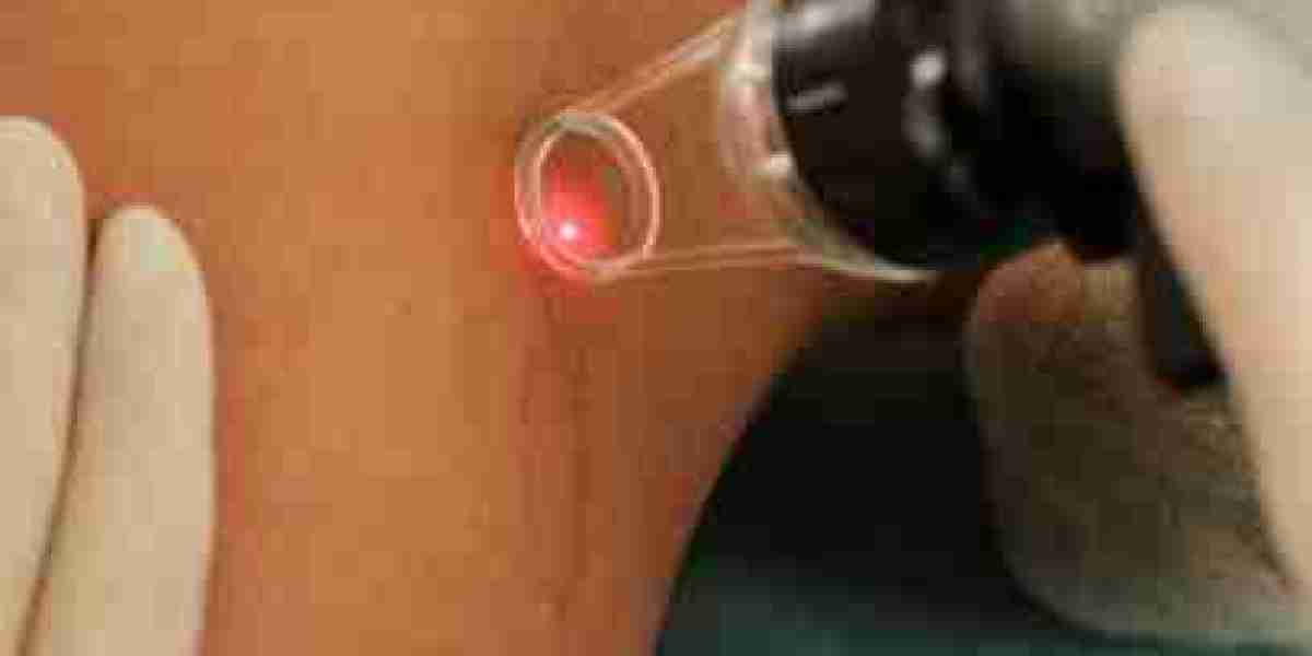 Are There Any Food or Lifestyle Restrictions Post Laser?
