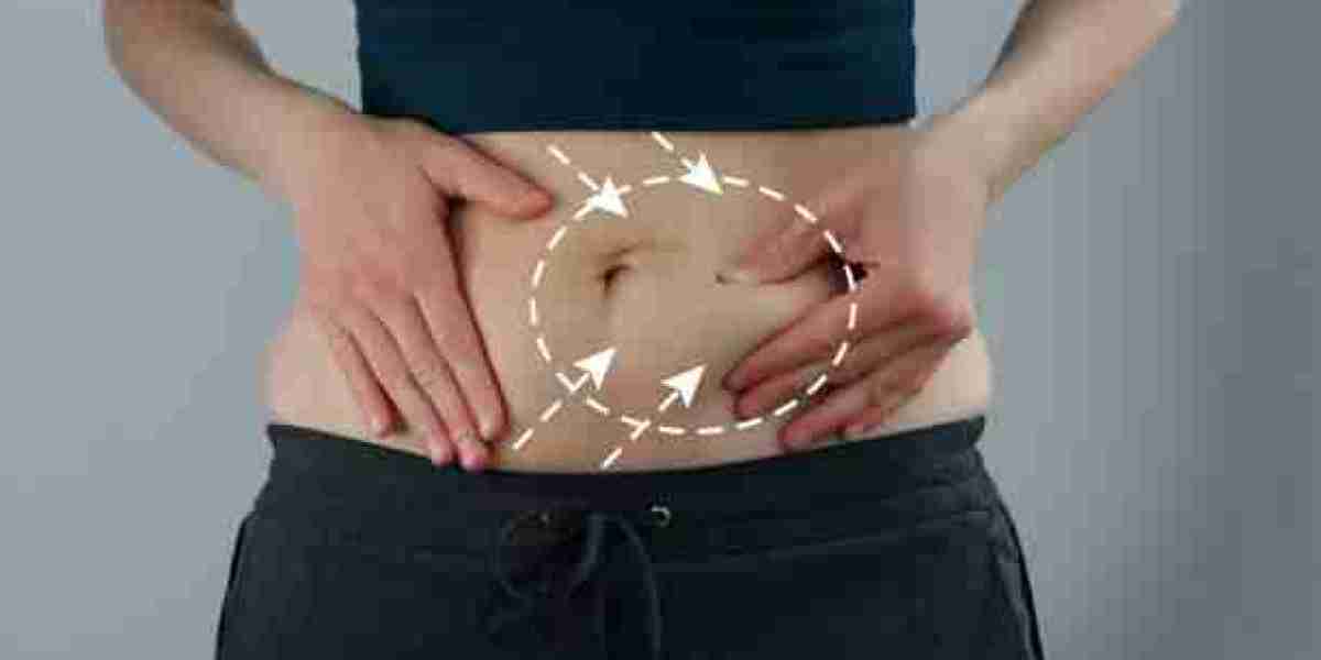 Riyadh Tummy Tuck Recovery: A Comprehensive Guide to Healing