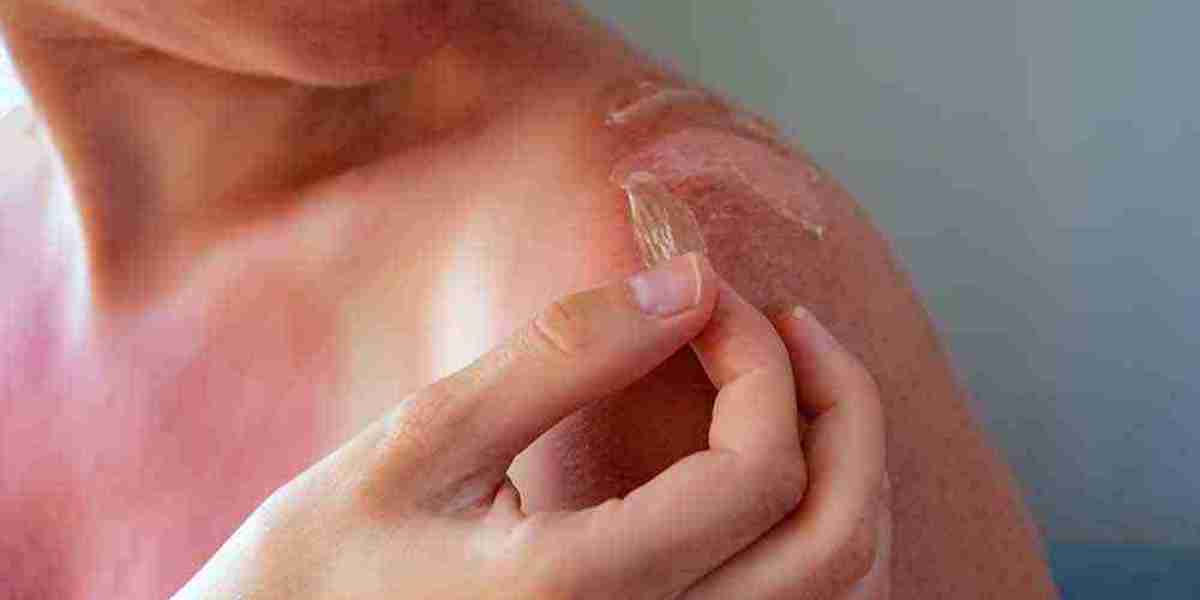 Risks of reconstructive burn surgery explained