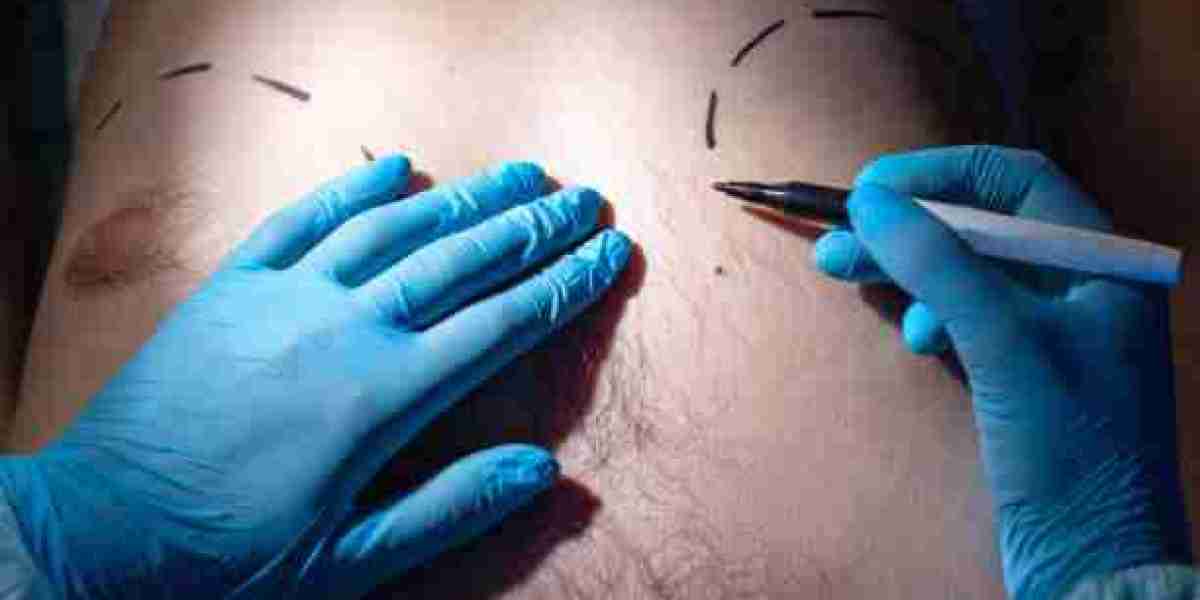 Riyadh Chest Contouring: Reclaiming Confidence with Gynecomastia Surgery