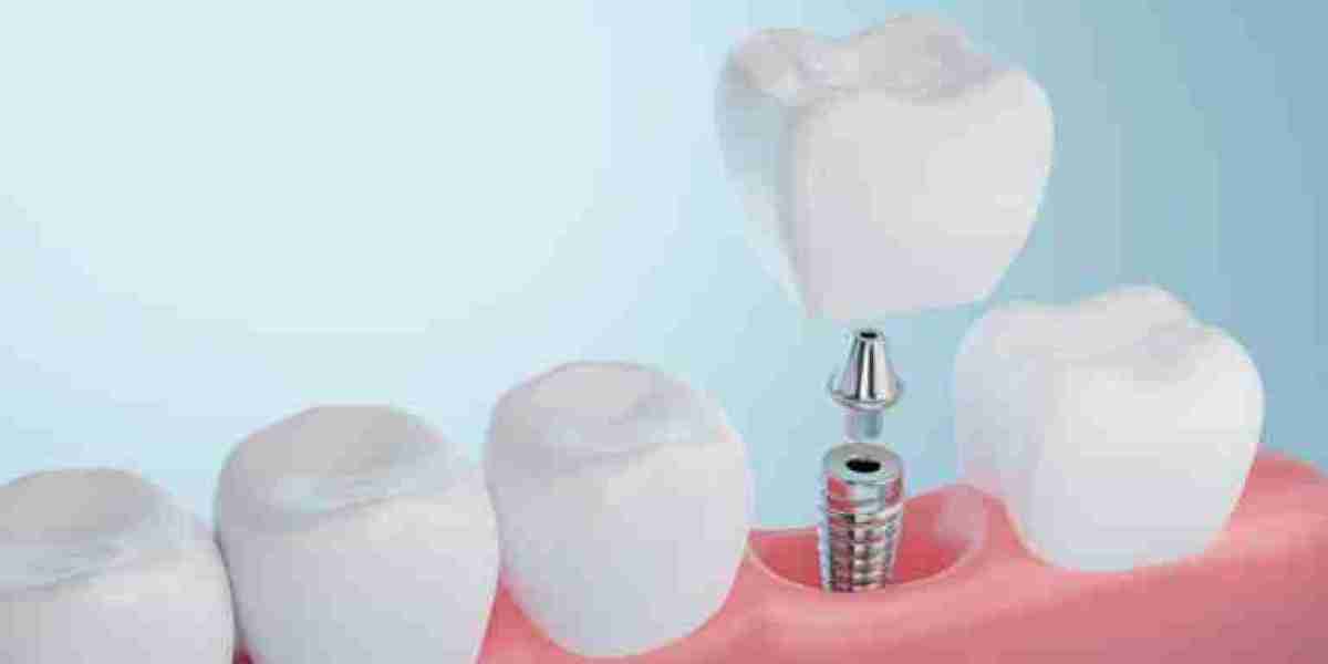 Will My Insurance Cover Dental Implants?