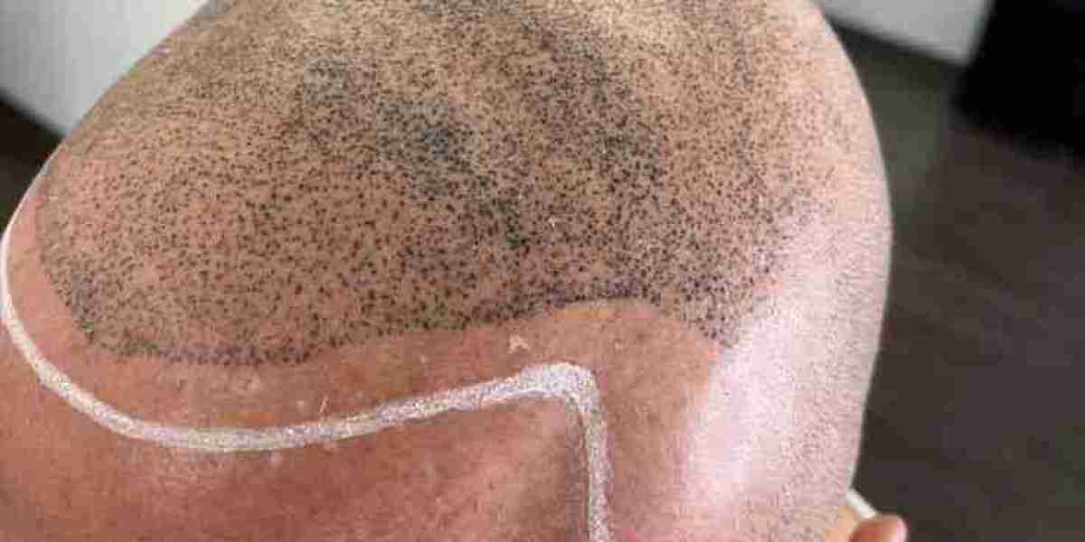 Platelet-Rich Plasma Riyadh Benefits