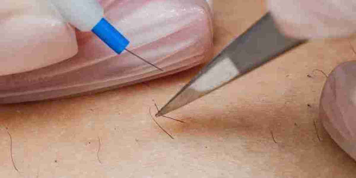 Riyadh Electrolysis: Unveiling a Smooth Future for Facial Hair