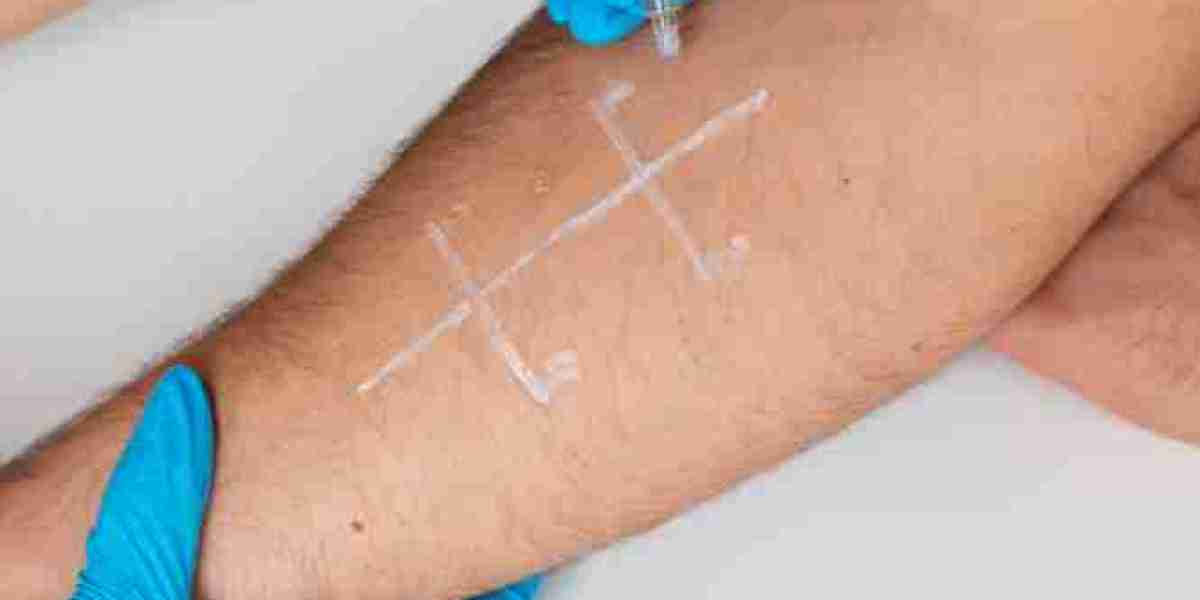 Sclerotherapy: What You Need to Know