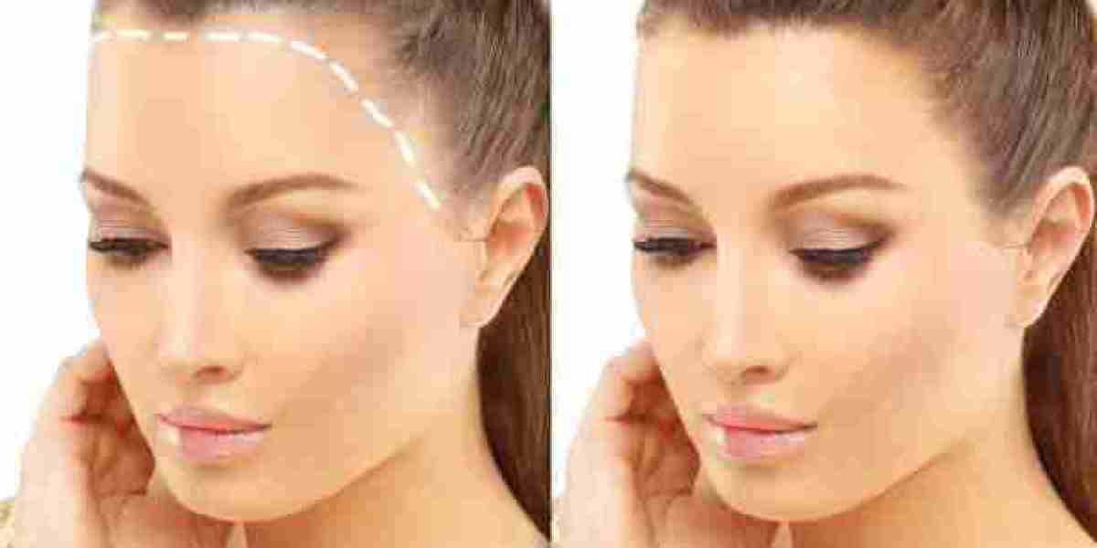 Hair Transplant in Riyadh: Is It Right for You?