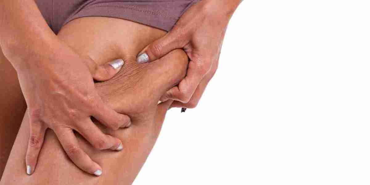 What Is Cellulite and Why Does It Form?