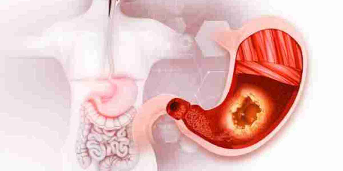 Gastric Balloon Results Riyadh: Unlocking Your Weight Loss Potential