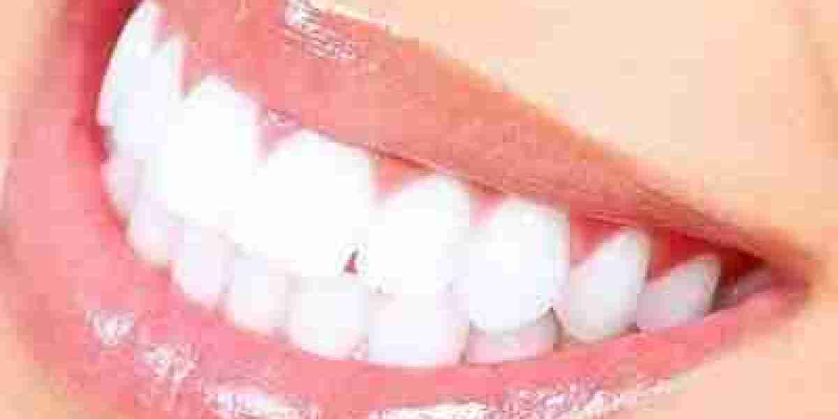 Are There Any Long-Term Effects of Laser Whitening?