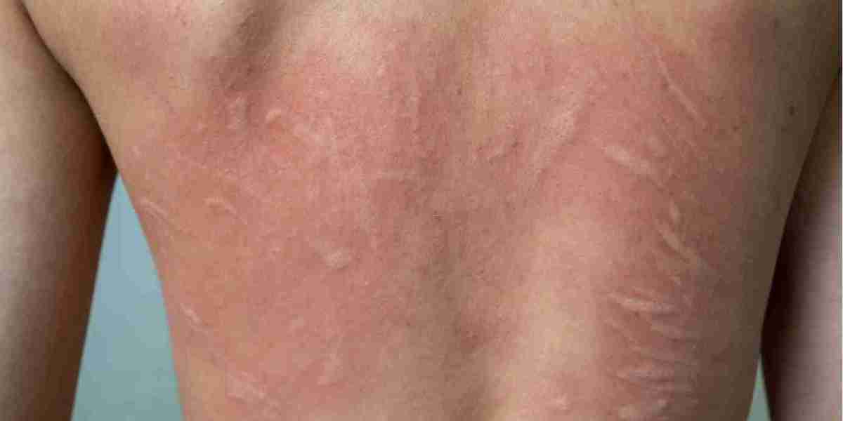 Can Urticaria Be Prevented with Lifestyle Changes?