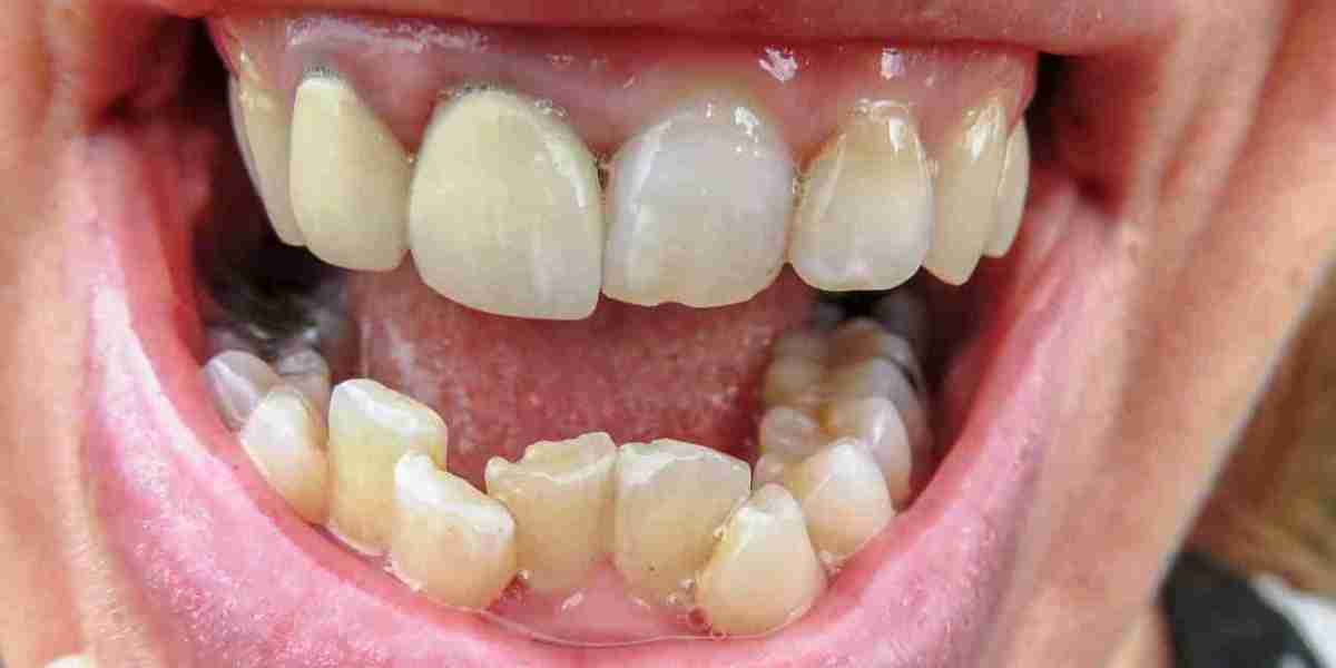 Can Aligners Work on Severely Overlapping Teeth?