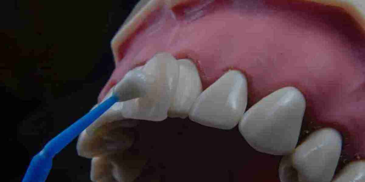 What Color Is Dental Bonding Cement?