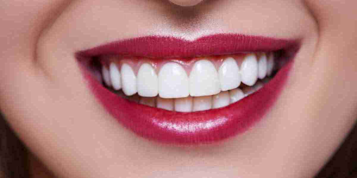 Are Veneers a Better Option Than Braces or Aligners in Dubai?