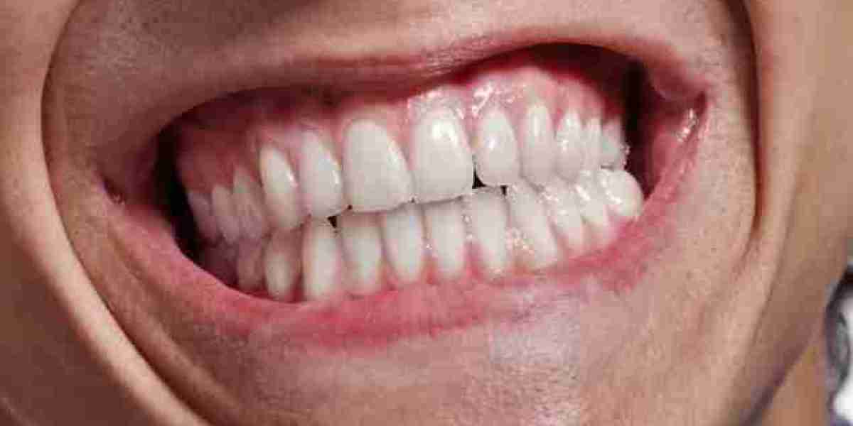 Can Grinding Teeth Cause Headaches or Ear Pain?