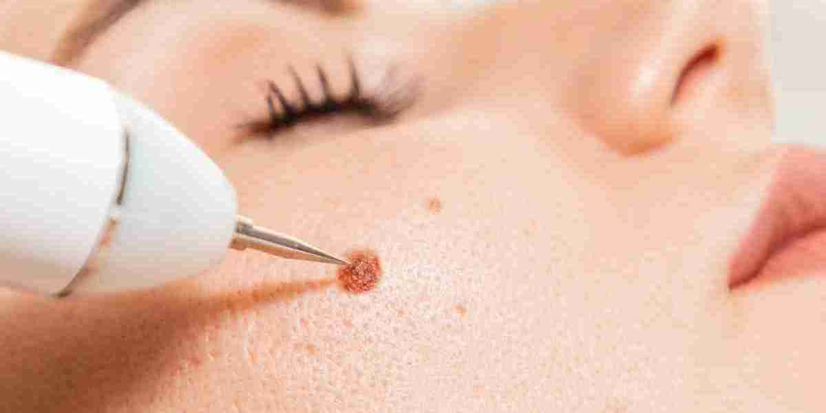 Separating Fact from Fiction in Wart Removal Treatments