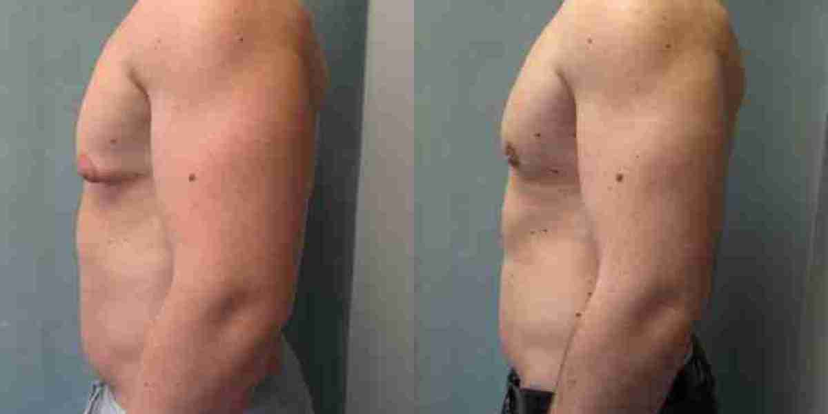 Are There Non-Surgical Alternatives to Gynecomastia Surgery in Riyadh?