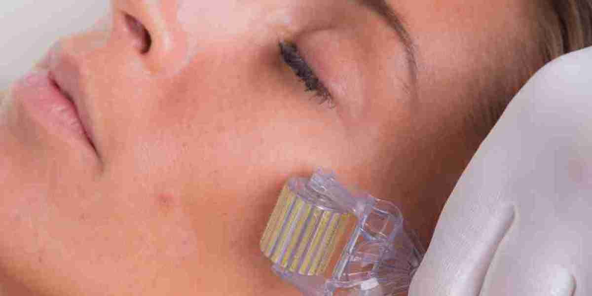 Micro-needling for acne scars: Downtime explained